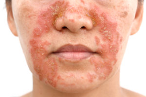 treatment for eczema on face