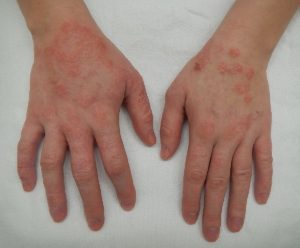 treatment of dermatitis