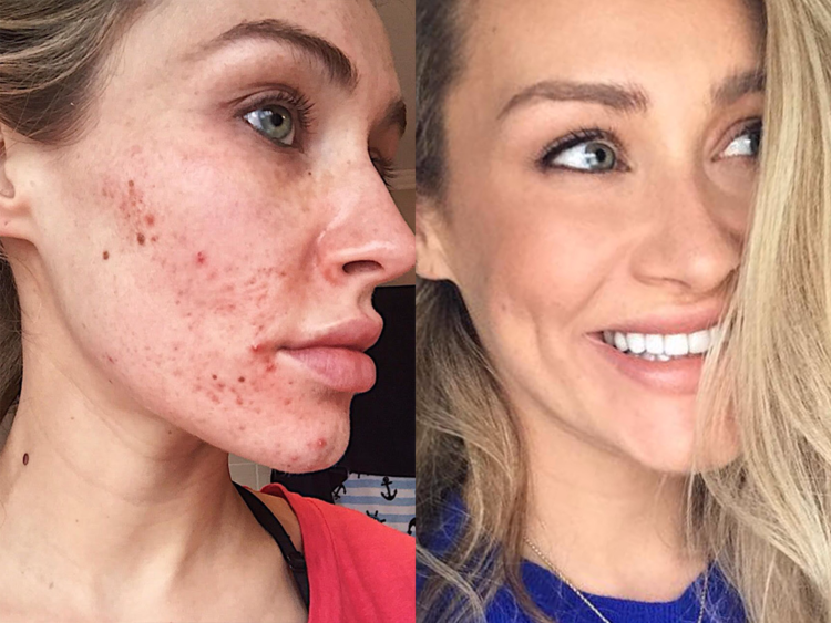 Acne Treatment Laser Before And After